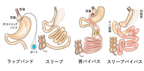 肥満外科治療イラスト